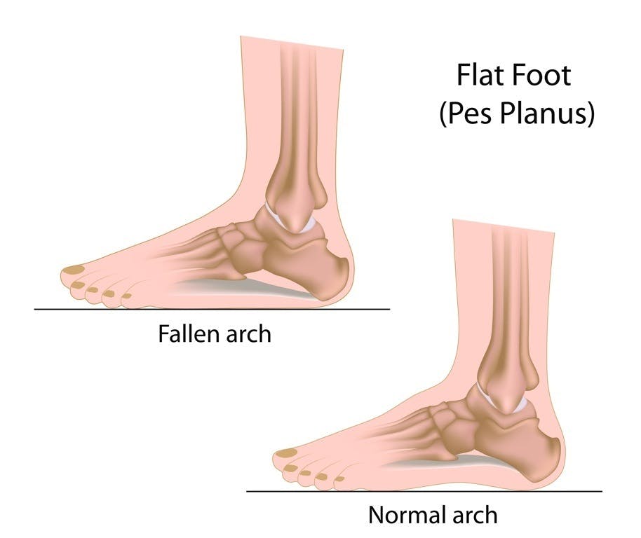 Healthy foot vs. Flat foot inside look