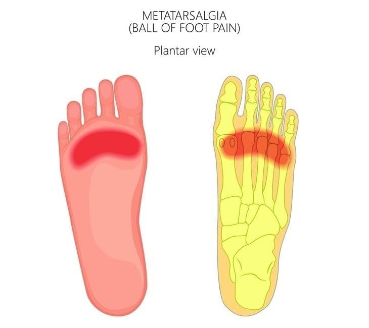 Ball of Foot Pain (Metatarsalgia)