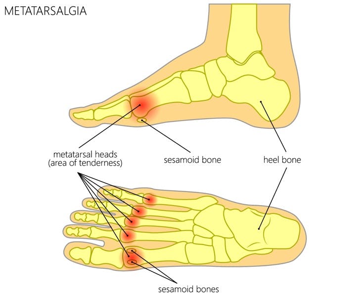 Metatarsal heads (area of tenderness): Plantar and Side views