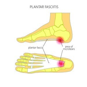 Platar fasciitis: side view and bottom view