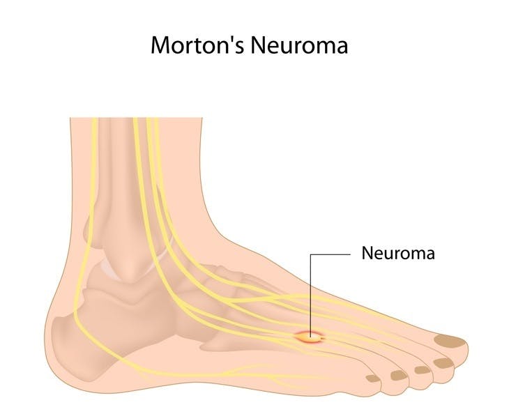 Neuroma position on foot