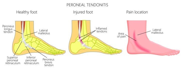 Peroneal tendonitis: Pain location