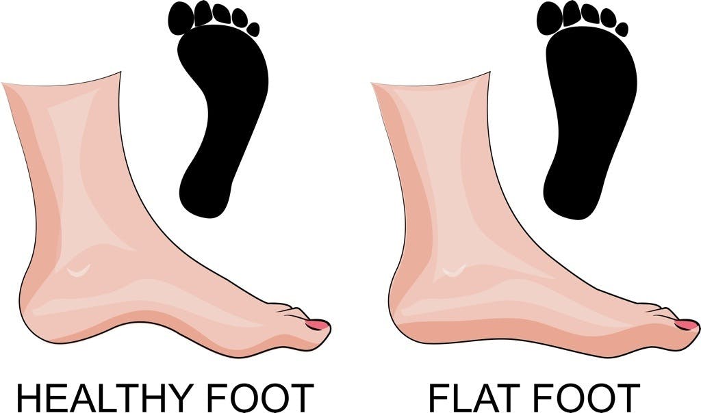 healthy foot and flat foot footprints