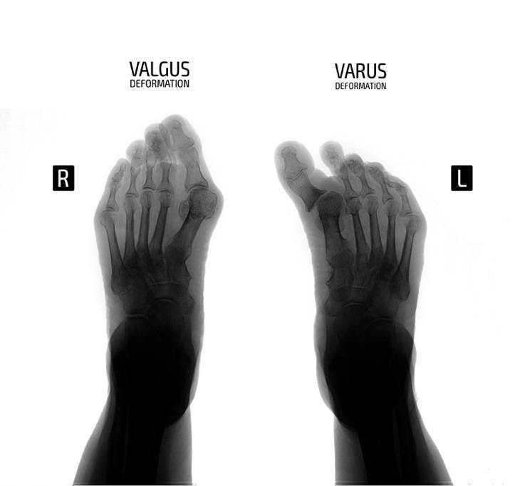 xray foot varus-valgus deformity 1st
