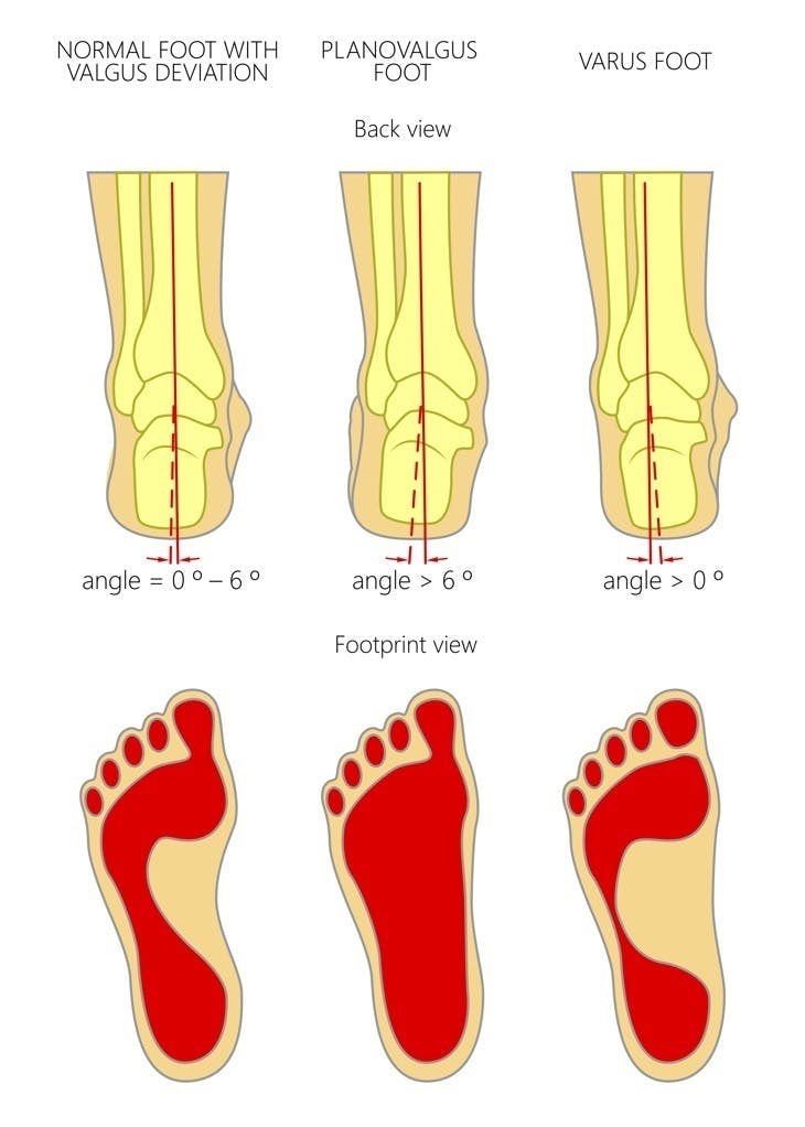 illustration of normal planovalgus varus feet footprint