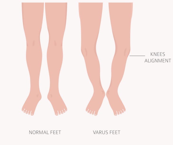 foot deformation medical desease infographic valgus