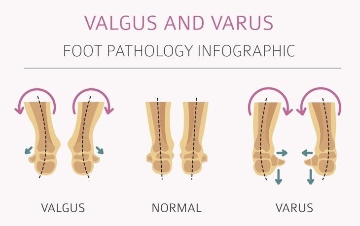 foot deformation medical desease infographic valgus and varus